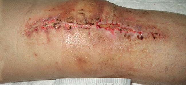 wound healing