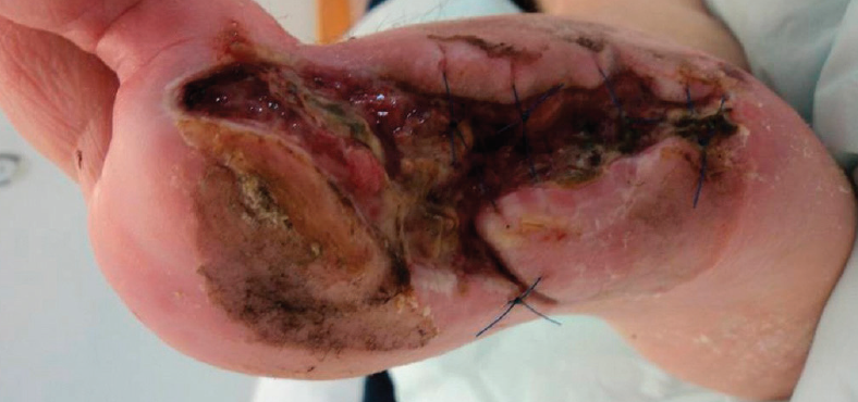 Amputation wound prior to treatment