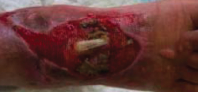 Initially prior to debridement of the wound