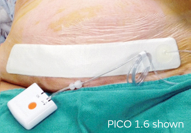 C section Clinical Evidence Possible With PICO c-section-clinical-evidence-possible-with-pico