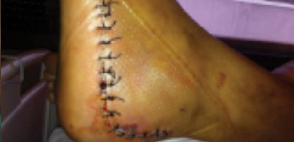 calcaneal surgery