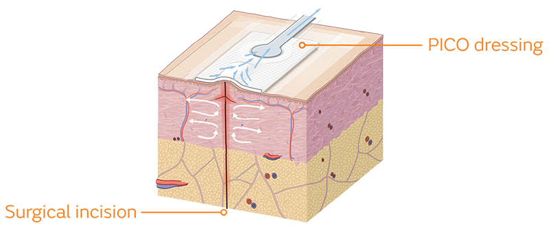 PICO dressing and incision cross section