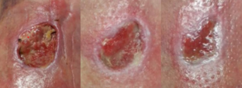 Venous leg ulcer