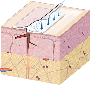 Scar illustration