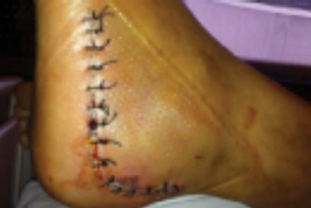 Calcaneal surgery