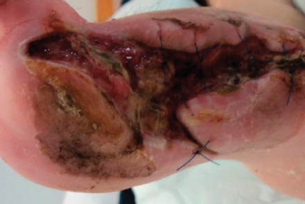 Diabetic foot ulcer